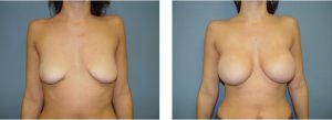 נתוח הגדלת חזה - תמונה לפני ואחרי 13
