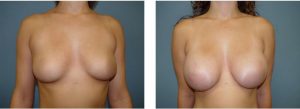 נתוח הגדלת חזה - תמונה לפני ואחרי 15