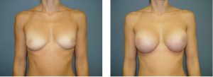 נתוח הגדלת חזה - תמונה לפני ואחרי 18