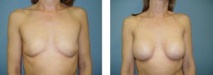 נתוח הגדלת חזה - תמונה לפני ואחרי 19
