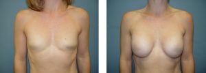נתוח הגדלת חזה - תמונה לפני ואחרי 2