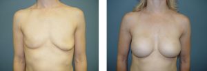 ניתוח הגדלת חזה לפני ואחרי 3