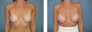 נתוח הגדלת חזה - תמונה לפני ואחרי 4