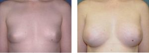 נתוח הגדלת חזה - תמונה לפני ואחרי 8